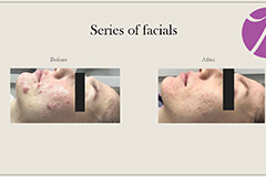 Acne-3-thumb