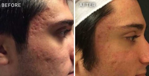 Acne Scar Case 1