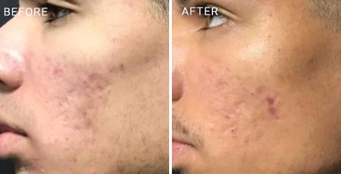 Acne Scar Case 2