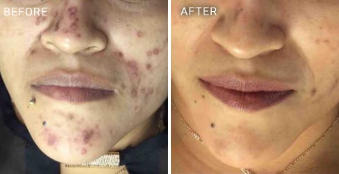 Acne Scar Case 3