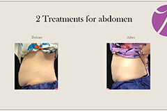 Coolsculpting-1-thumb