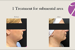 Coolsculpting-2 Thumb