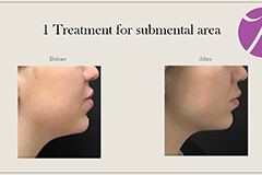 Coolsculpting-3 Thumb