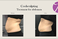 Coolsculpting-4 Thumb