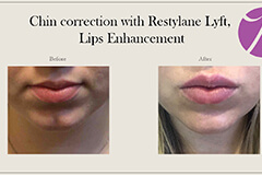 Lip Fillers-1-thumb