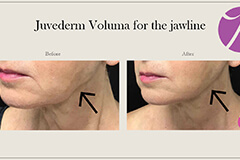 Lips Enhancement 2 Thumb