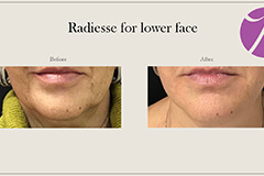 Lips Enhancement 3 Thumb