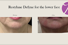 Lips Enhancement 4 Thumb