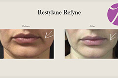 Lips Enhancement 5