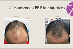 Hairloss 1