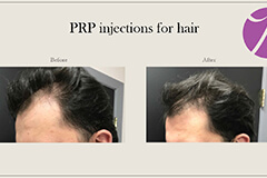 Hairloss 2