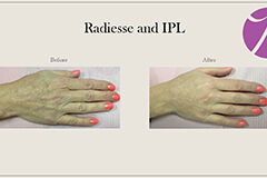 Hands Rejuvenation