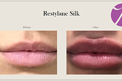 Lips Enhancement 6