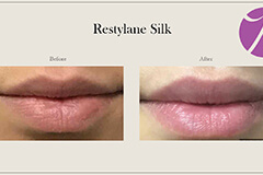 Lips Enhancement 7