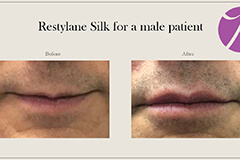 Lips Enhancement 8