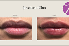 Lips Enhancement 9