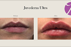 Lips Enhancement 11