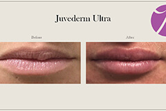 Lips Enhancement 12