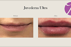 Lips Enhancement 13