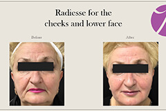 Liquid Face Lift