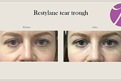Restylane-2