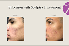 Subcision with sculptra