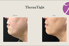Thermithight-1