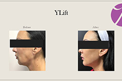 YLift