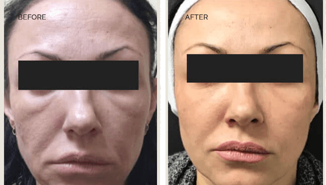 Sculptra Actual Patient Results - 03