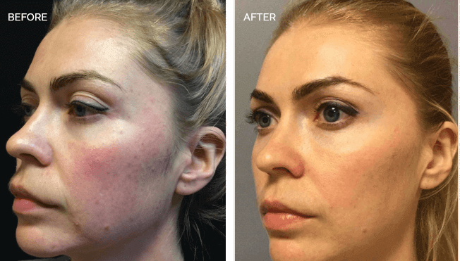 Sculptra Actual Patient Results - 04