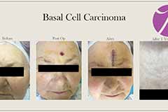 MOHS Surgery on Basal Cell Carcinoma