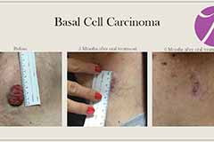 Basal Cell Carcinoma