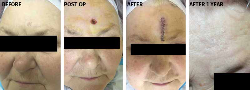 MOHS Before and After Images 1