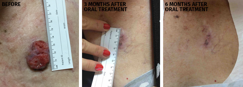 Before and After MOHS Procedure 3