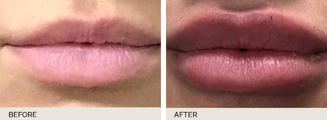 Restylane Actual Patient Results - 01