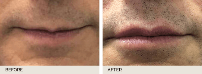 Restylane Actual Patient Results - 02