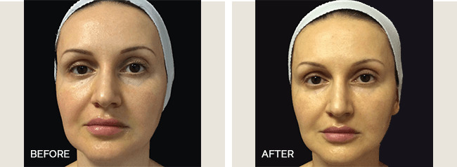 Restylane Actual Patient Results - 03