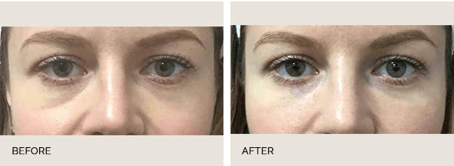Restylane Actual Patient Results - 04