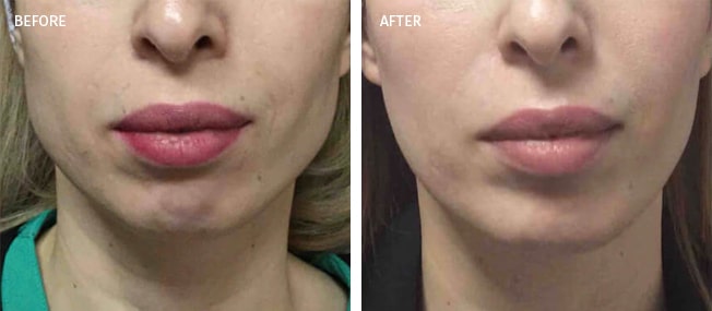 before and after actual patient of Botox