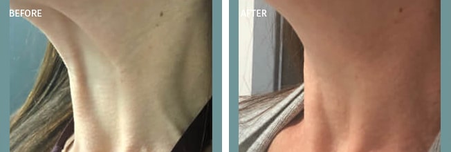 Botox Actual Patient Results - 01