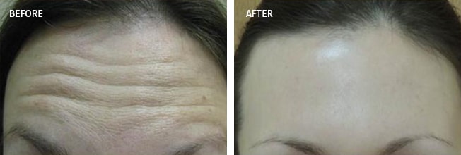Dysport Actual Patient Results - 02