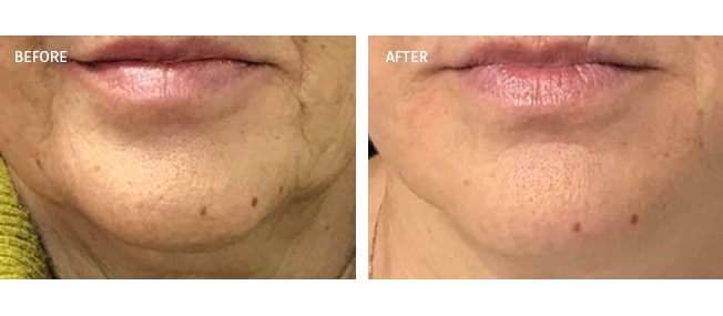 before and after actual patient of Radiesse Treatment