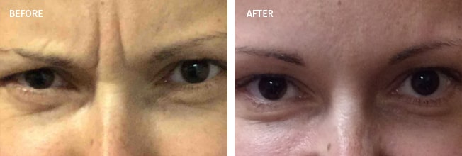 Xeomin Actual Patient Results - 03
