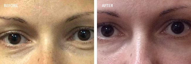 Xeomin Actual Patient Results - 04