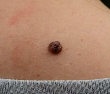 Warts behind the neck of Women