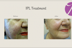 Redness and Rosacea Treatment Case 04