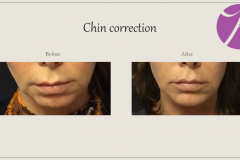 Cheeks, Nasolabial folds and Chin Treatment Before After Case 08