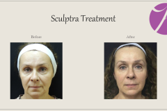 Sculptra for Rejuvenation Before After Case 04