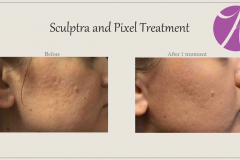 Sculptra for Rejuvenation Before After Case 08
