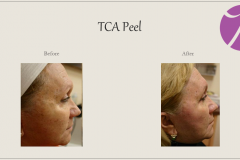 Chemical Peels and Microdermabrasion Before After Case 07